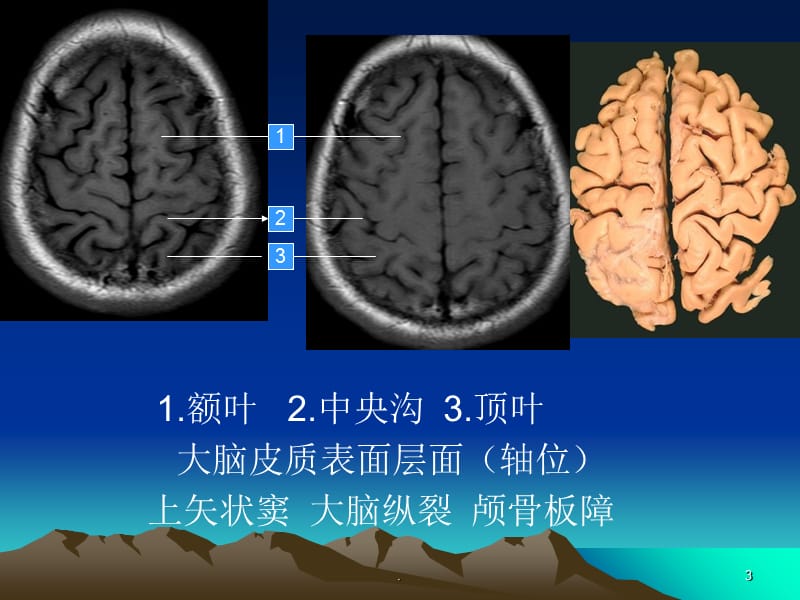 头颅MRI断层解剖PPT精选文档.ppt_第3页