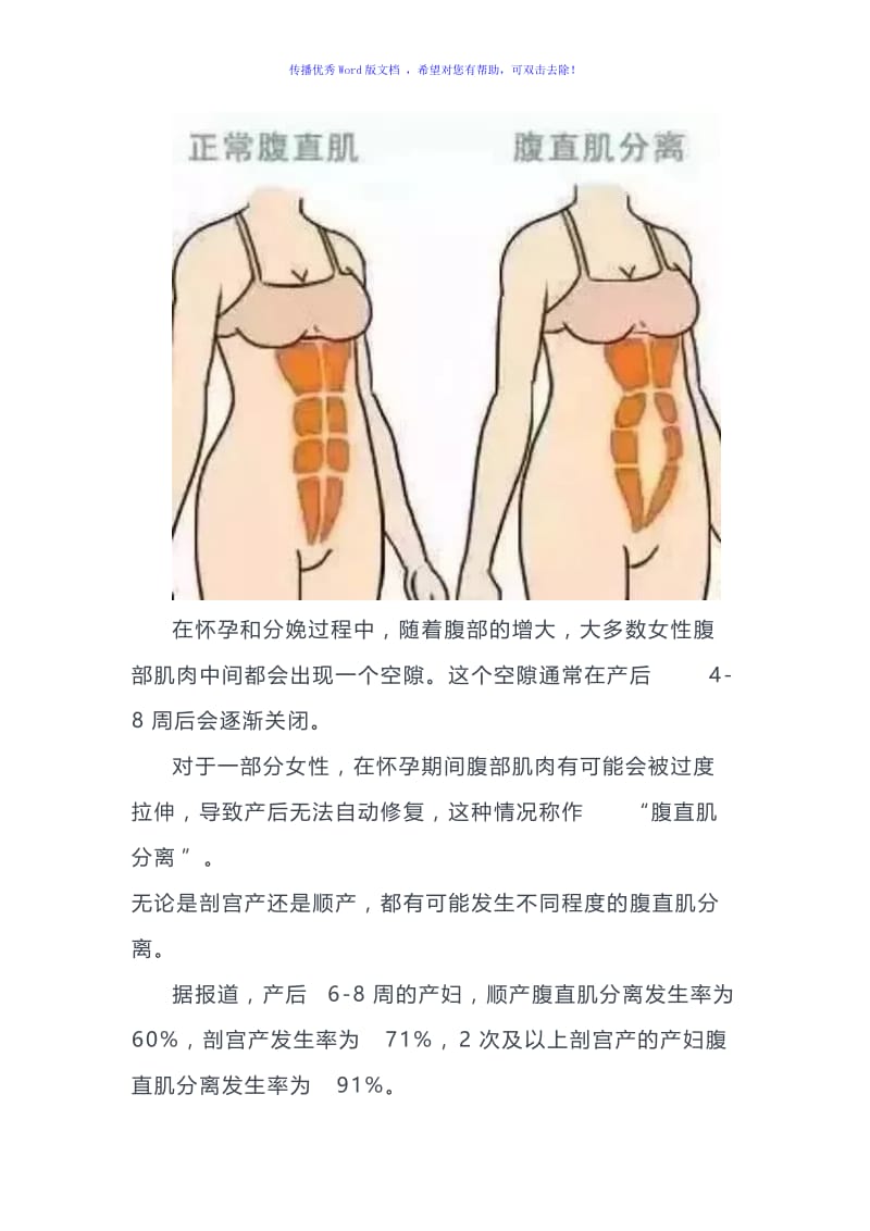 产后康复核心-腹直肌分离与训练方法(有图)Word版.doc_第2页