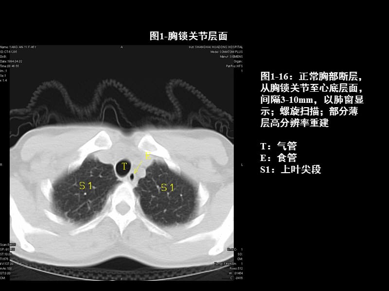 胸部CT的影像学表现PPT课件.ppt_第1页