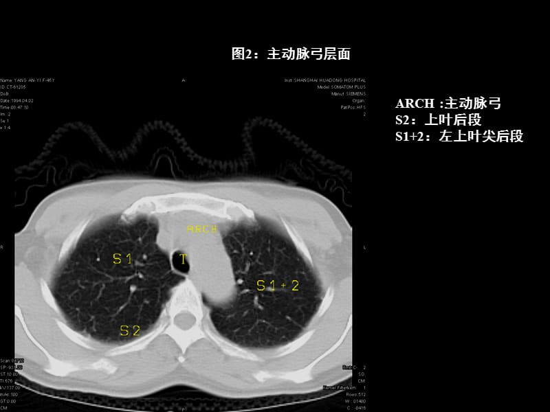 胸部CT的影像学表现PPT课件.ppt_第2页