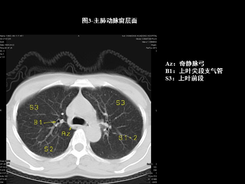 胸部CT的影像学表现PPT课件.ppt_第3页