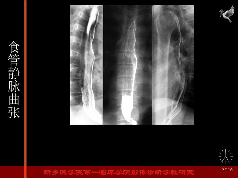 食管静脉曲张影像表现.ppt_第3页