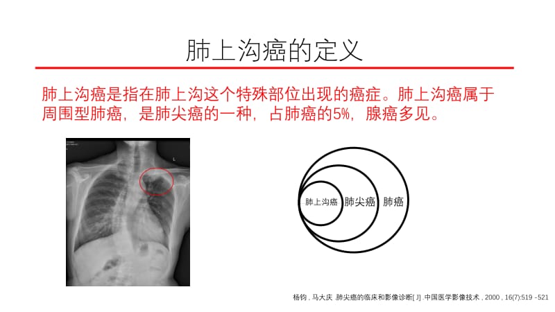 肺上沟癌的鉴别诊断.ppt_第3页