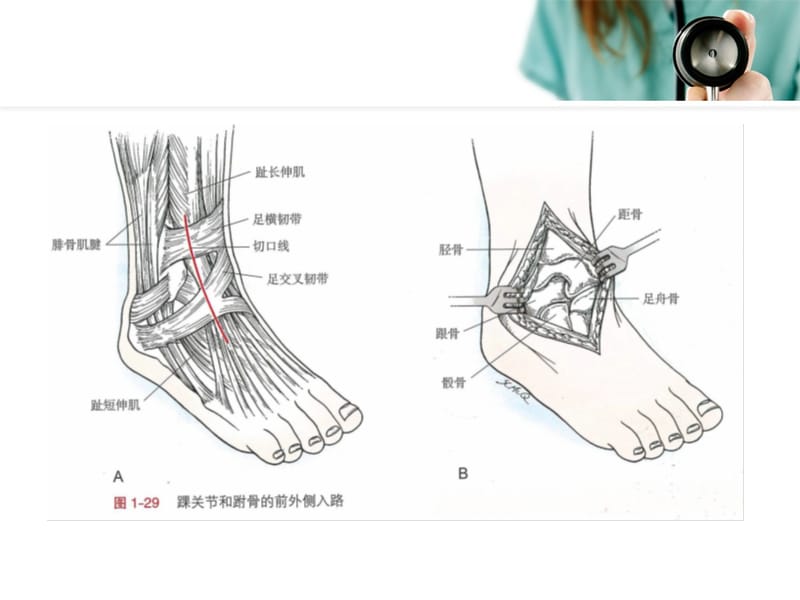 踝关节手术入路.ppt_第3页