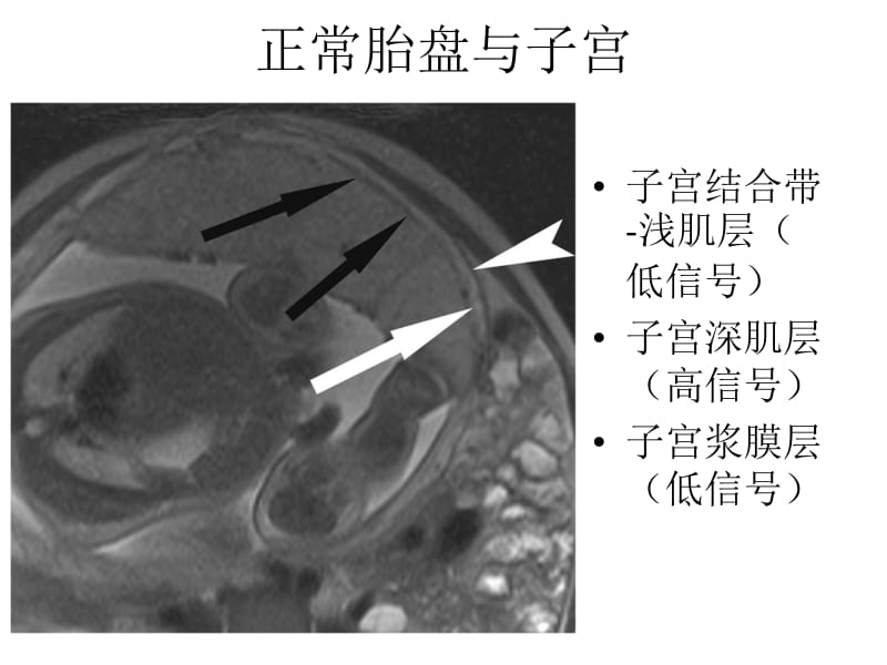 胎盘植入的磁共振表现.ppt_第3页