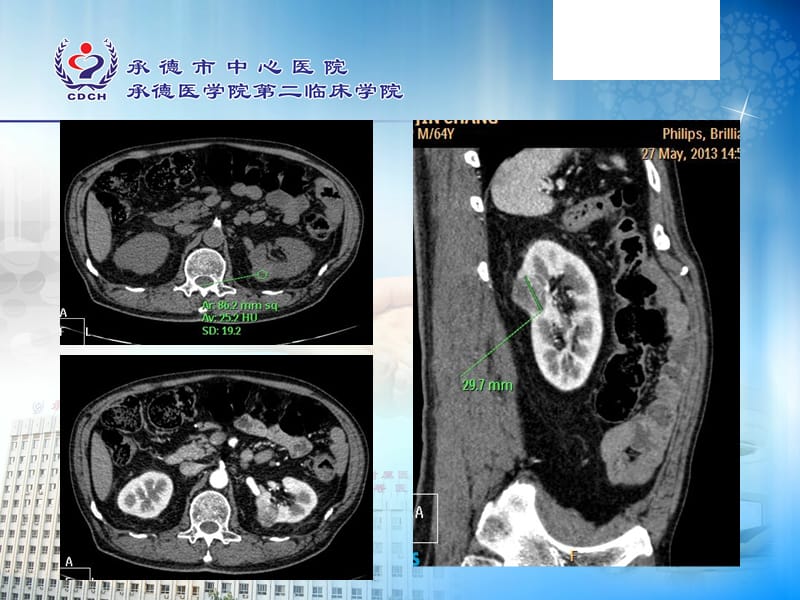 肾癌的CT表现.ppt_第3页