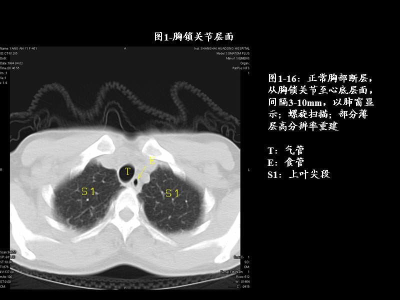 肺叶分段段ct.ppt_第1页