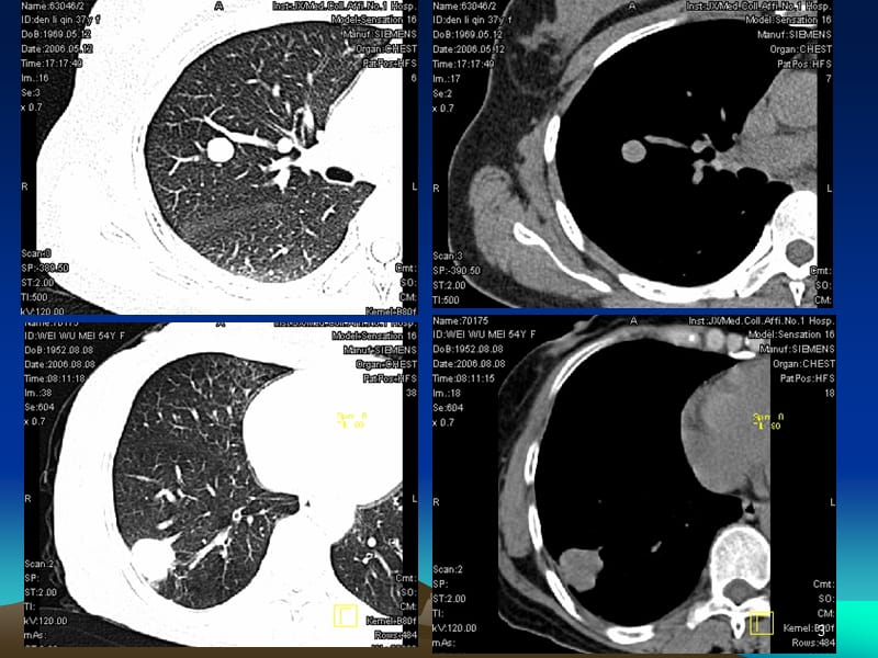 （推荐精选）肺结节的CT诊断和鉴别诊断.ppt_第3页