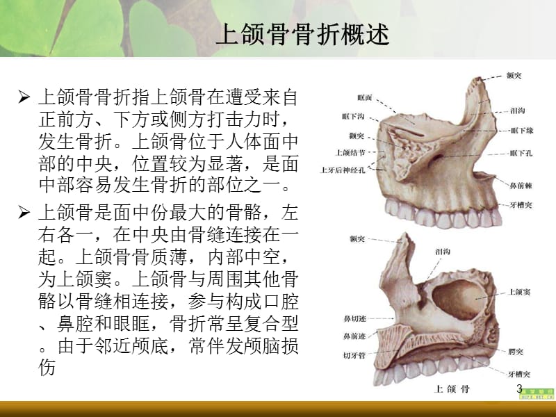 （推荐精选）上下颌骨骨折.ppt_第3页