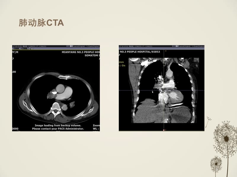 （推荐精选）肺栓塞CT诊断.ppt_第2页