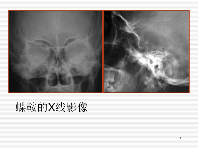 （推荐精选）垂体病变的MRI诊断.ppt_第3页