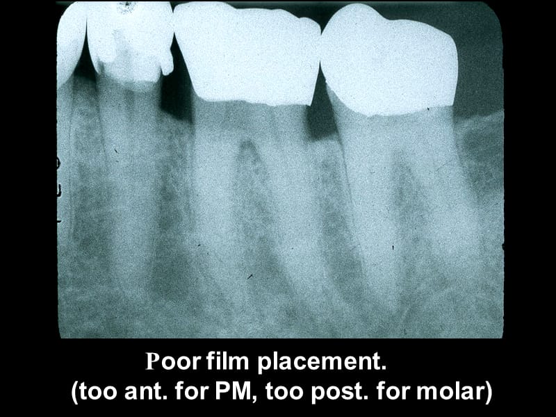 intra-oral tech-errors学会看拍牙课件.ppt_第3页
