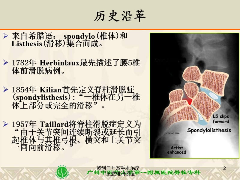 微创与开放手术治疗I-II度腰椎滑脱症课件.ppt_第2页