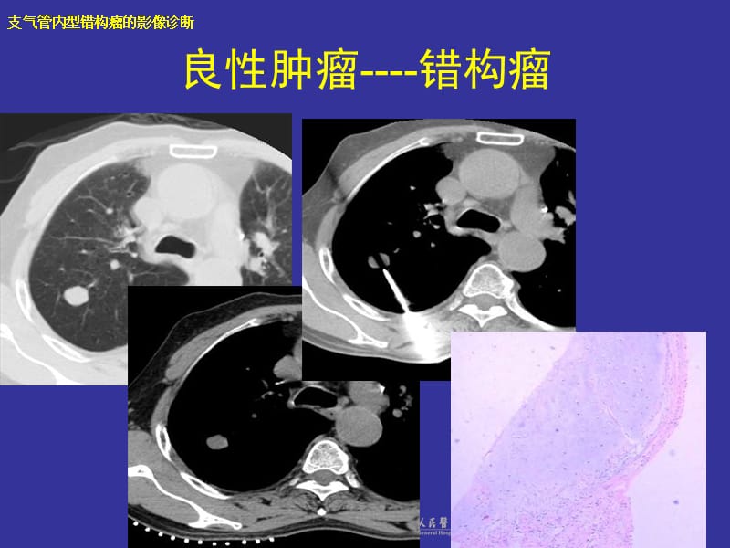 支气管内错构瘤的影像诊断课件.ppt_第1页