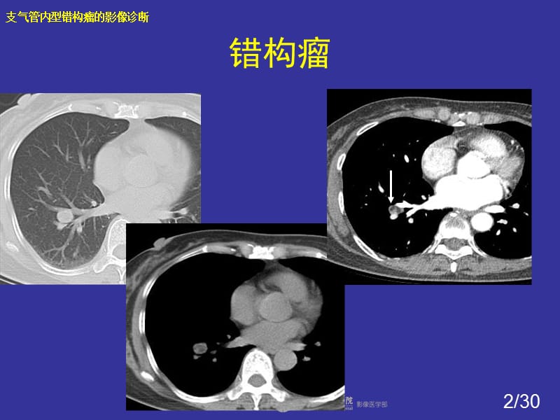 支气管内错构瘤的影像诊断课件.ppt_第2页