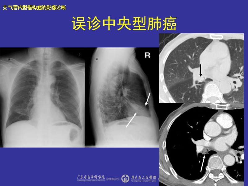 支气管内错构瘤的影像诊断课件.ppt_第3页