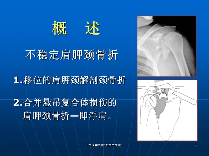 不稳定肩胛颈骨折的手术治疗课件.ppt_第2页