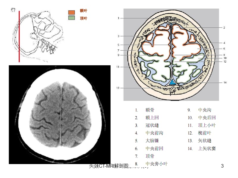 头颈CT-MRI解剖图解系列(5)课件.ppt_第3页