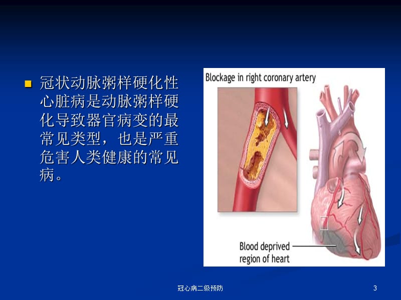 冠心病二级预防课件.ppt_第3页