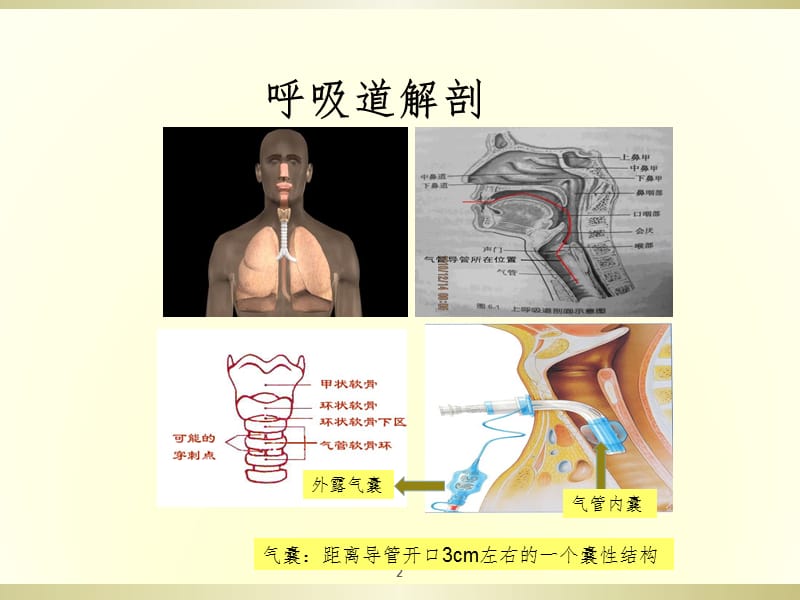 气管套管的气囊管理PPT课件.ppt_第2页