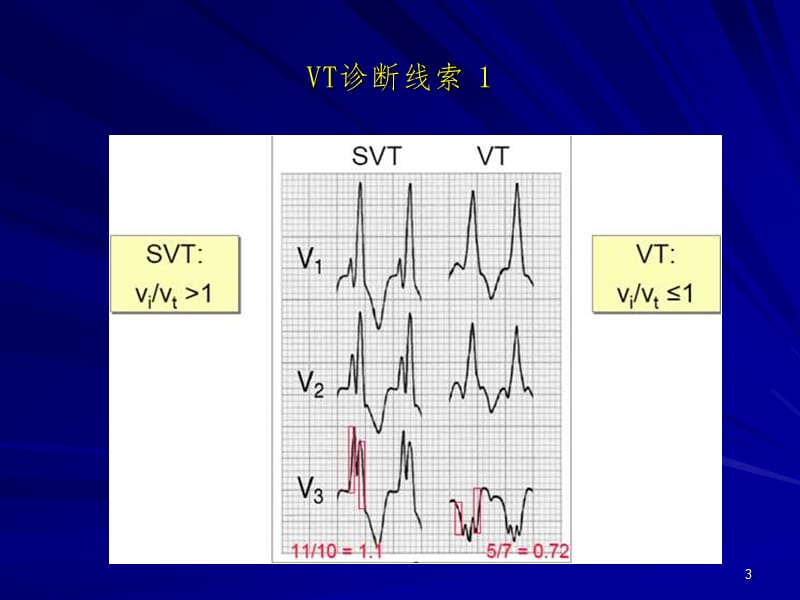 室性心律失常PPT课件.ppt_第3页