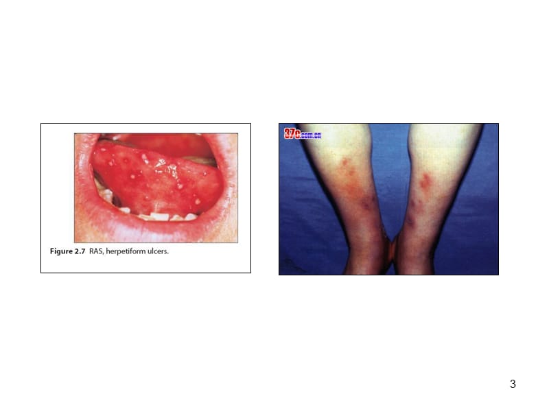 溃疡性结肠炎图片PPT演示课件.ppt_第3页
