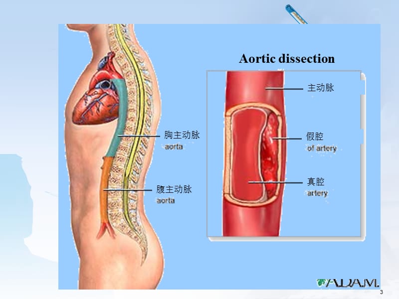 主动脉夹层的护理PPT演示课件.ppt_第3页