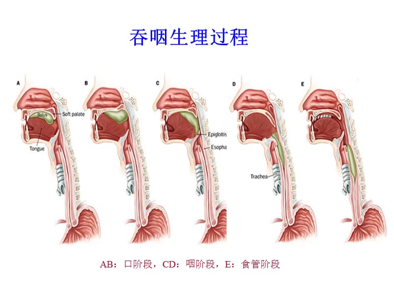 《脑卒中后吞咽困难》PPT课件.ppt_第2页