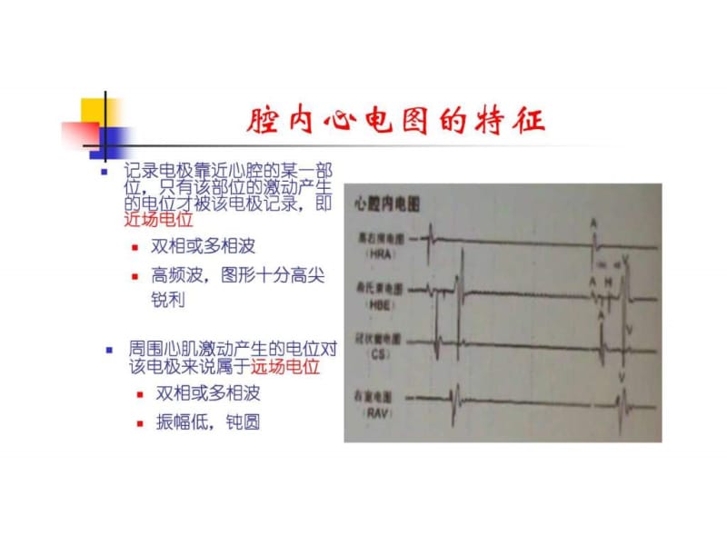 《腔内心电图》PPT课件.ppt_第3页