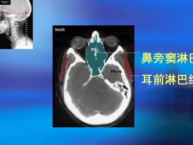 《头颈部淋巴结断层》PPT课件.ppt_第2页