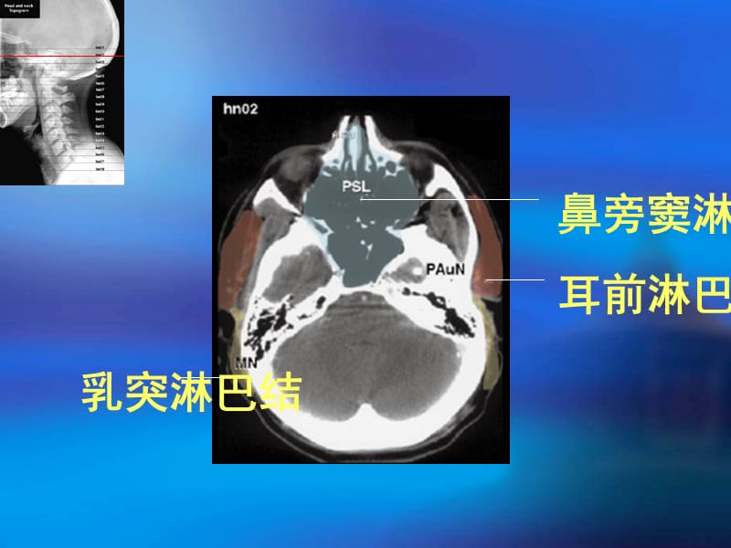 《头颈部淋巴结断层》PPT课件.ppt_第3页