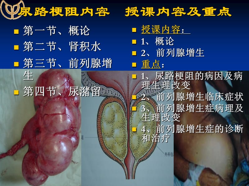 第五十一章节泌尿系梗阻 ppt课件.ppt_第2页