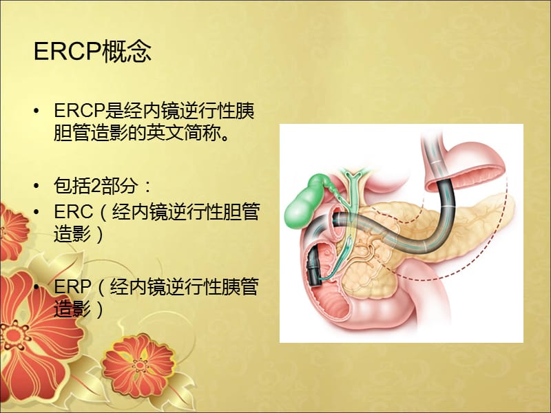 胆总管结石ERCP术围手术期护理.ppt_第3页