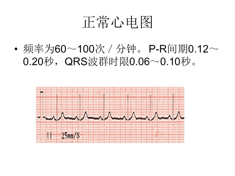 《心电监护常见图形》PPT课件.ppt_第3页