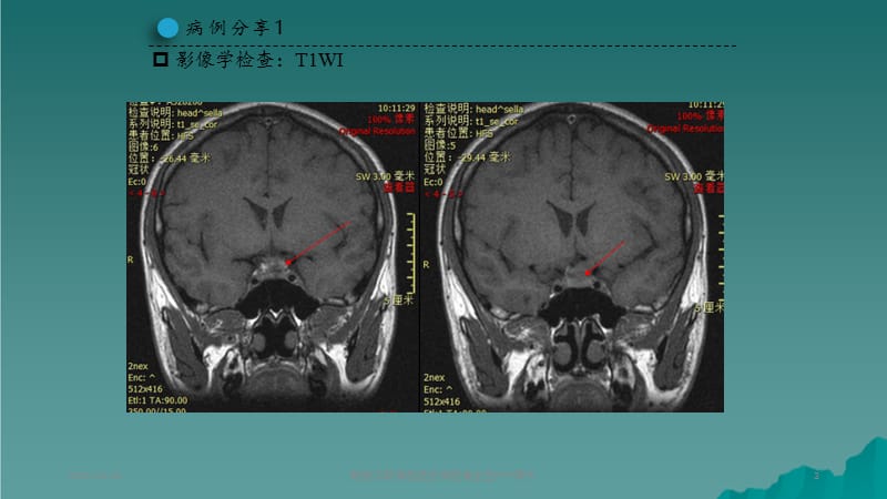 朗格汉斯细胞组织细胞增生症 (2).pptx_第3页