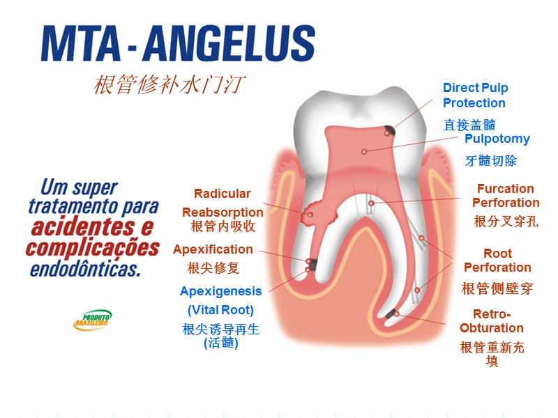 Proroot-MTA的临床应用课件.ppt_第3页