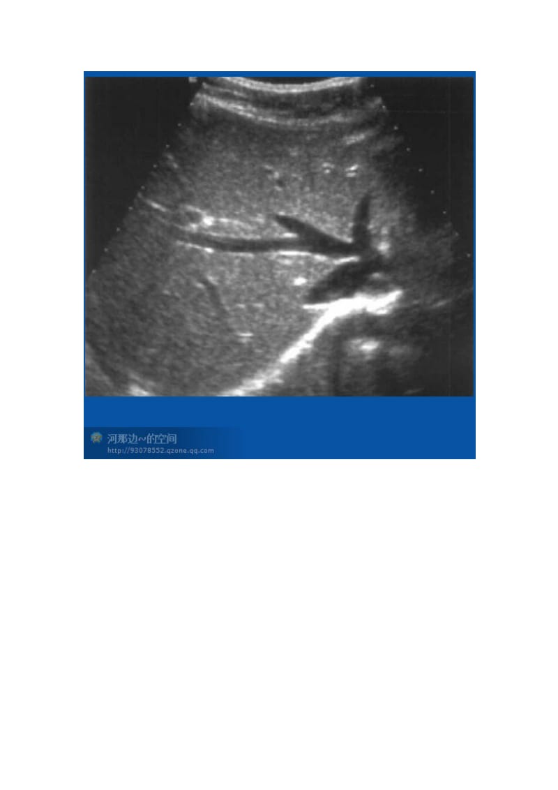 20个肝脏超声切面你常用哪几种切面来应对肝脏方面的检查.doc_第3页