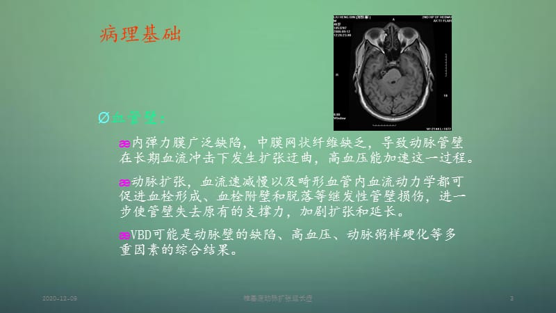 椎基底动脉扩张延长症（新）.ppt_第3页