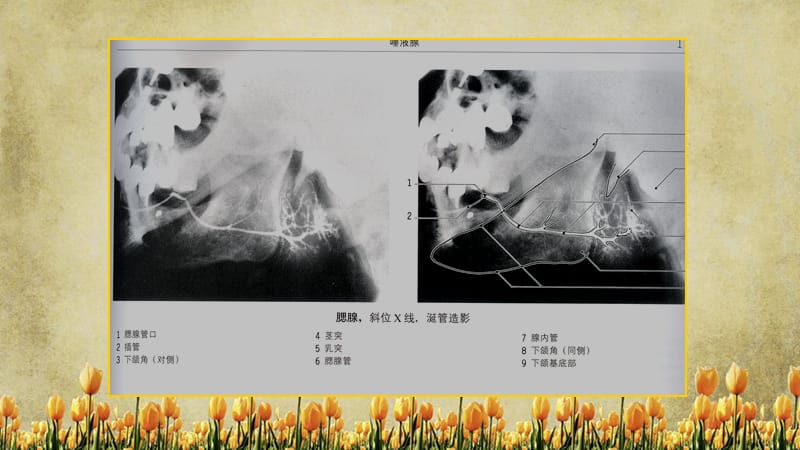 腮腺疾病的影像诊断（精选干货).ppt_第2页