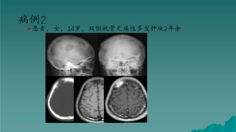 颅骨肿瘤影像学表现 (2).ppt_第3页