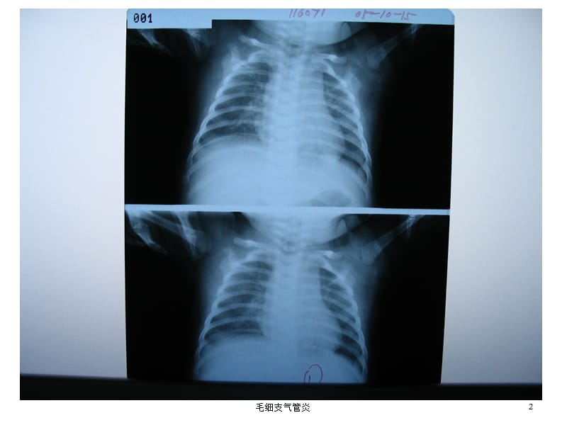 毛细支气管炎课件.ppt_第2页