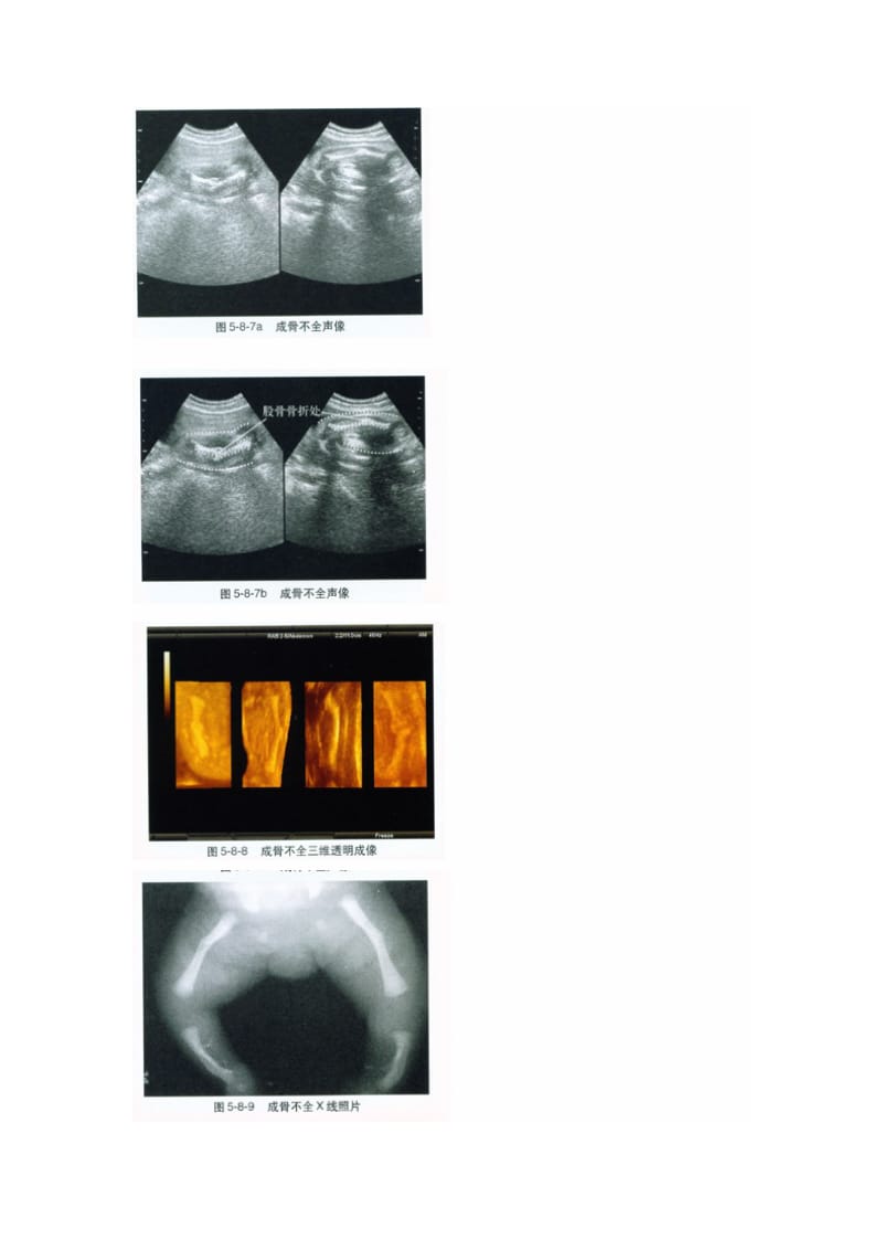 常见胎儿骨发育不良的超声表现.doc_第2页