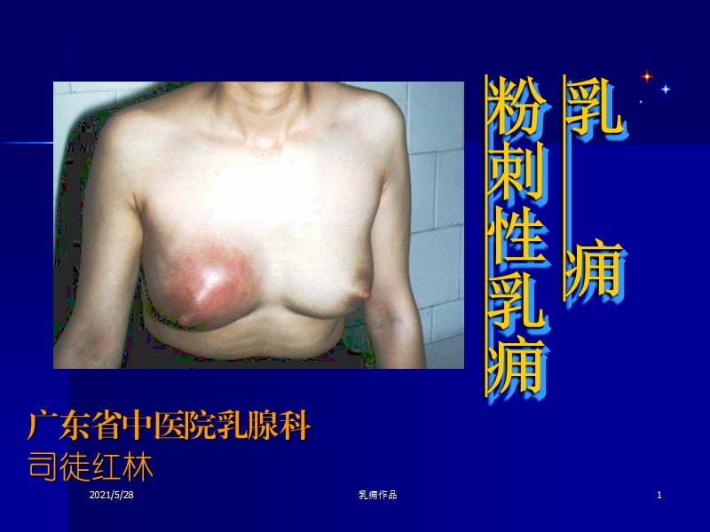 乳痈作品课件.ppt_第1页