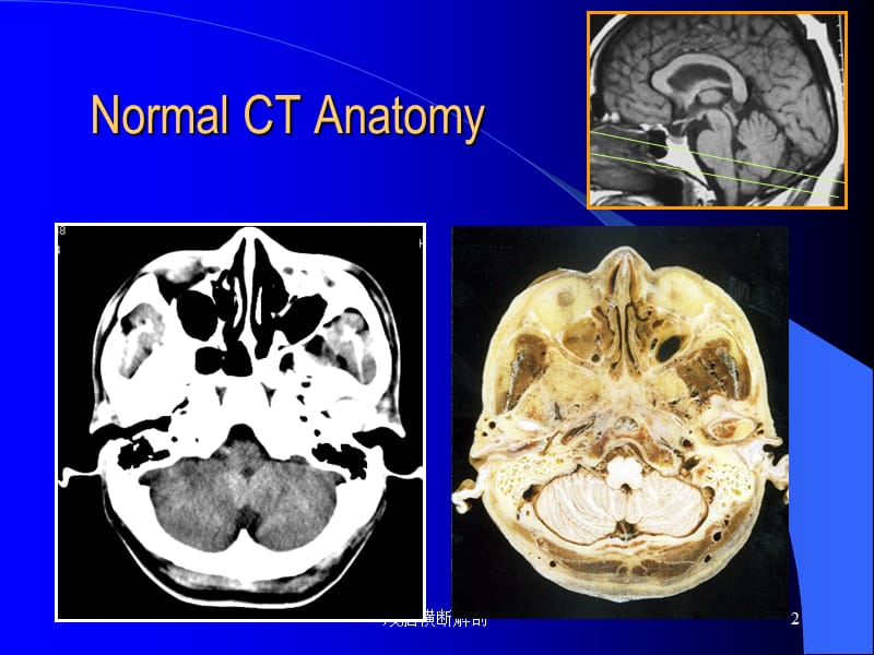 颅脑横断解剖课件.ppt_第2页