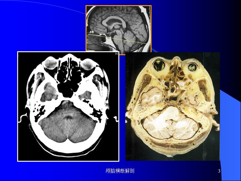 颅脑横断解剖课件.ppt_第3页