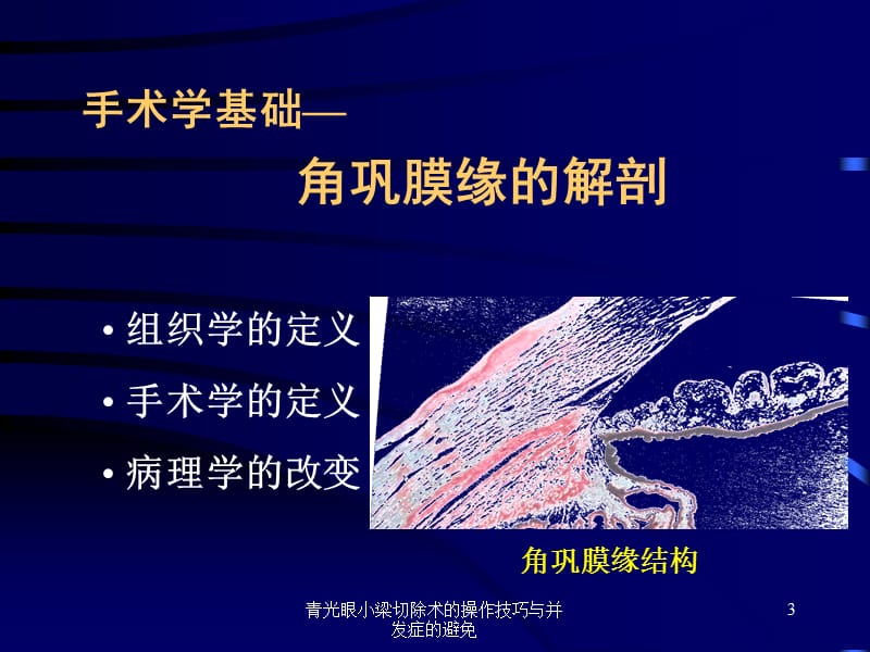 青光眼小梁切除术的操作技巧与并发症的避免课件.ppt_第3页