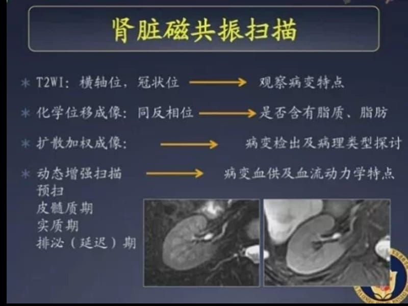 肾细胞癌MRI诊断及鉴别诊断-文档资料.ppt_第3页