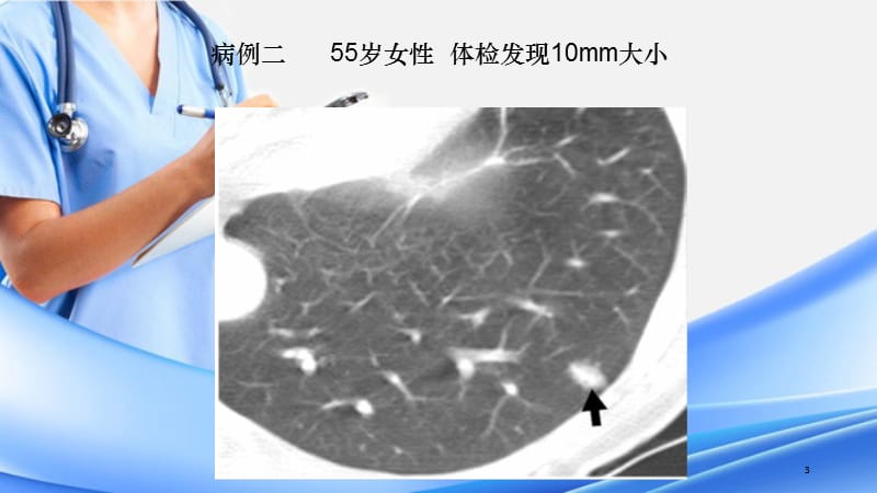 肺磨玻璃阴影影像诊断及临床处理原则（PPT精选课件)（精选干货）.ppt_第3页