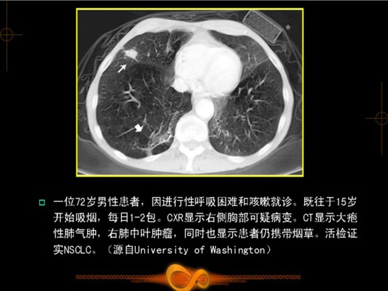 肺部肿瘤影像学诊断.ppt_第2页