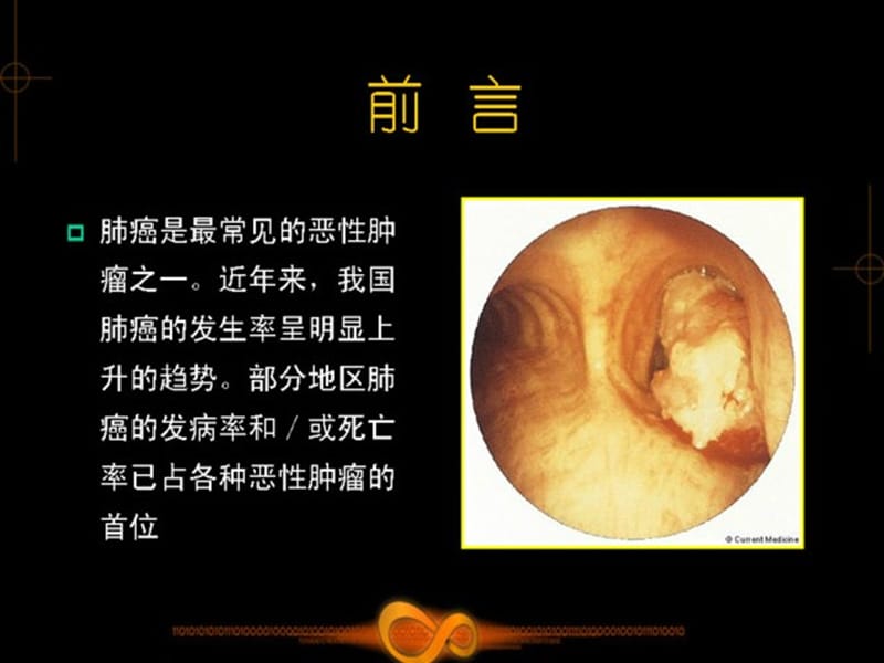 肺部肿瘤影像学诊断.ppt_第3页